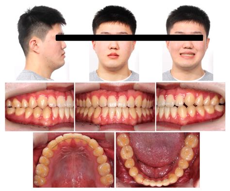 牙齒丟屋頂|牙齒掉了丟屋頂？ – 黃郁芩醫師 Orthodontics